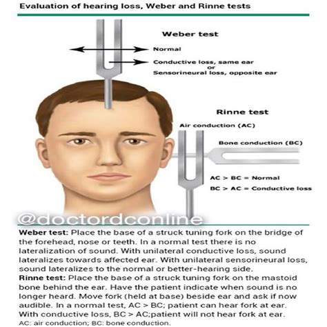 ncbi rinne test